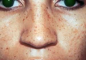  лентиго петна 