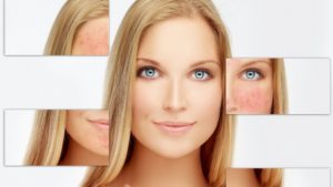  изсветляване на кожата 