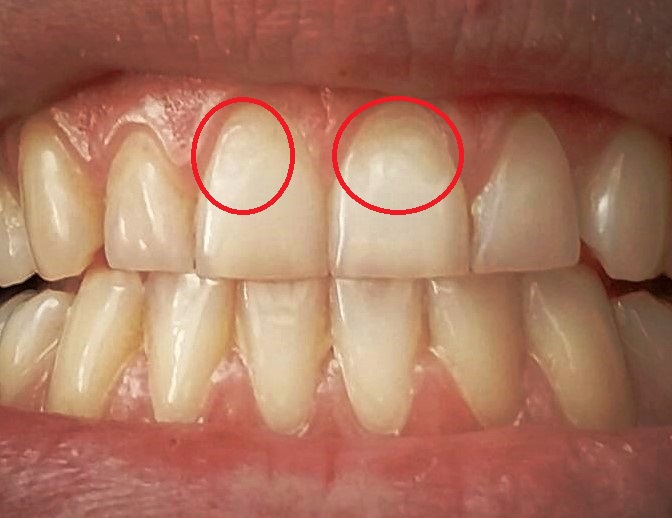 Как да се справим при наличието на флуороза, съветва зъболекарят